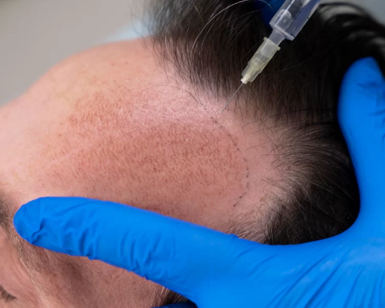 Best Hair Clinic & Hair Specialist in Wakad, & Nearby Areas Best Hair Clinic & Hair Specialist in Wakad, & Nearby Areas